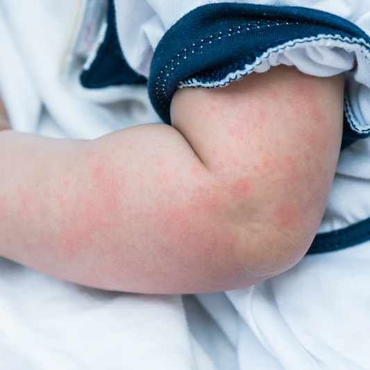 The Eczema-Gut Connection: Why We Need to Look Deeper Than the Skin